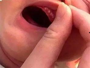 小孩吃瓜嘴巴周边红肿,嘴巴周边红肿的烦恼与对策